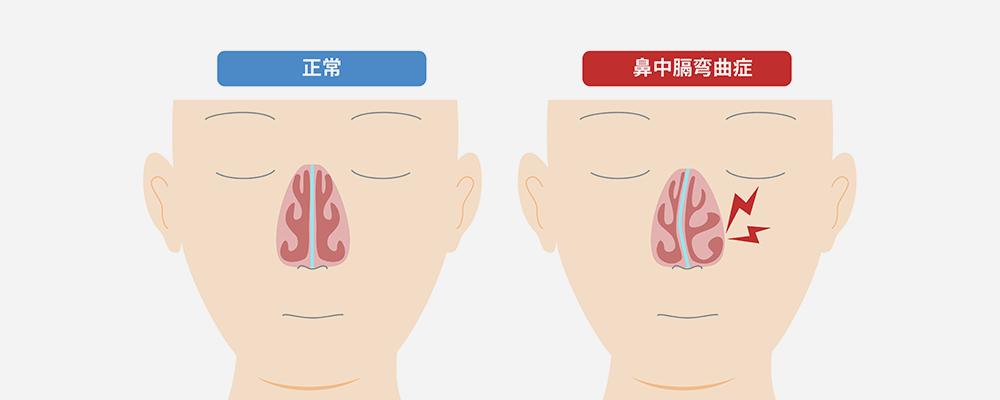 鼻中隔湾曲症